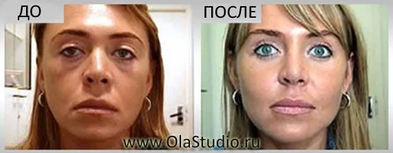 Мезонити - результаты